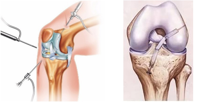 Операция колено пкс. Операция пластика ПКС коленного сустава. Разрыв связок коленного сустава ПКС операция. ПКС (передняя крестообразная связка).