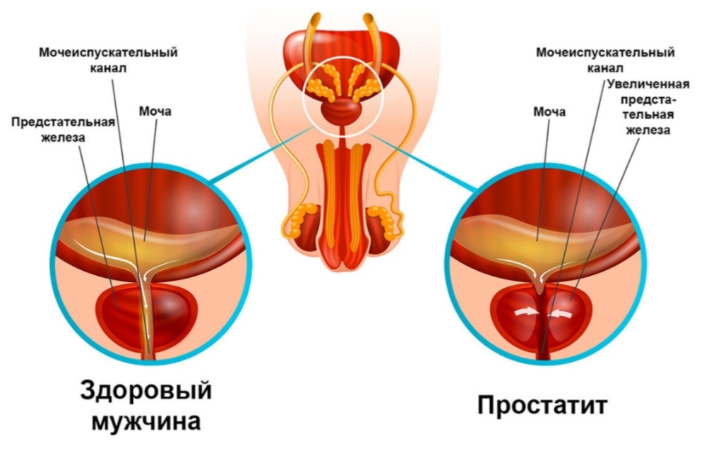 Лечение застойного простатита в Санкт-Петербурге