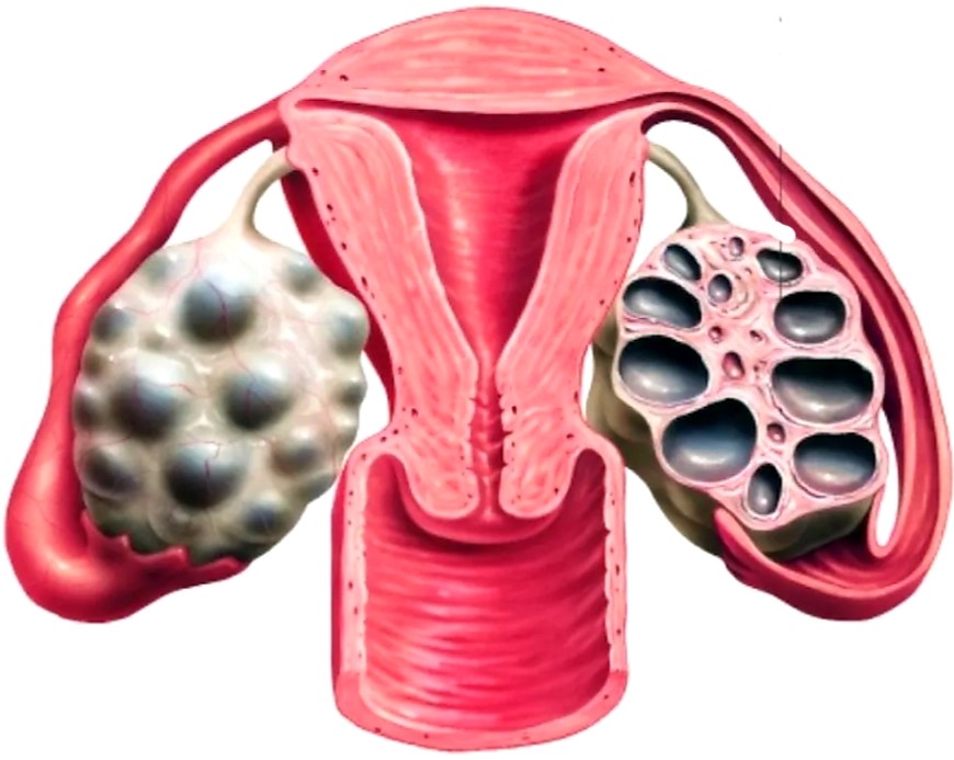 Поликистоз яичников у женщин
