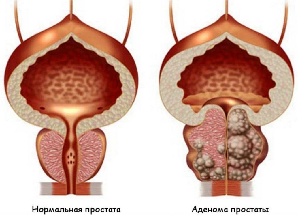 Лечение аденомы простаты у мужчин в Хабаровске - Медикъ