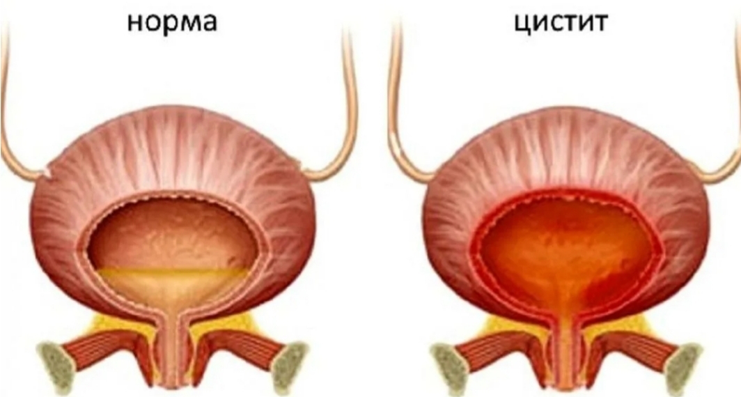 Мочевой пузырь воспаление