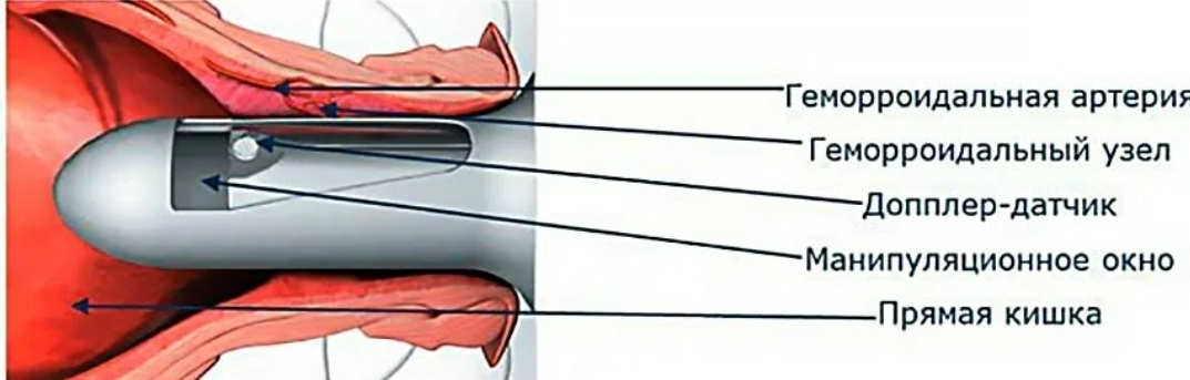 Как лечить внутренний геморрой у женщин препараты схема