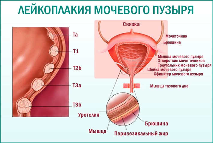 Заболевание лейкоплакия мочевого пузыря