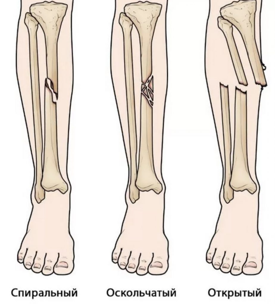 Перелом длинных костей
