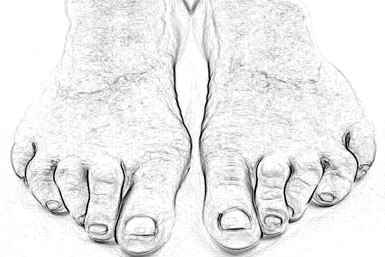 заболевание - молоткообразная деформация пальцев стопы