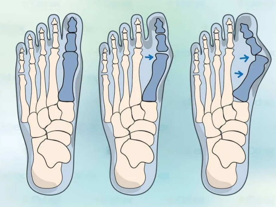 заболевание - вальгусная деформация 1 пальца стопы