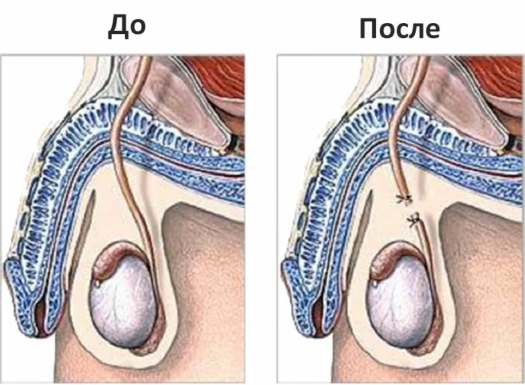 Отрезают Член