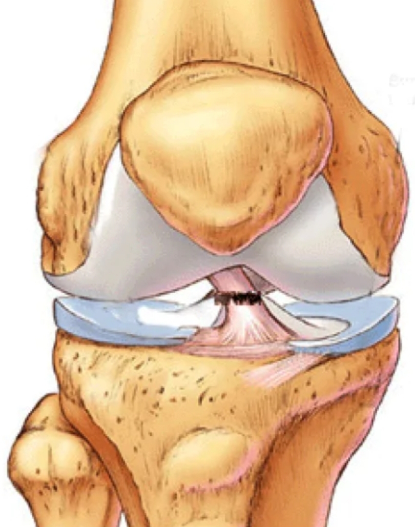 Повреждение коленной связки симптомы. Мениски коленного сустава анатомия. Разрыв капсульно связочного аппарата. Связки мениска коленного сустава.