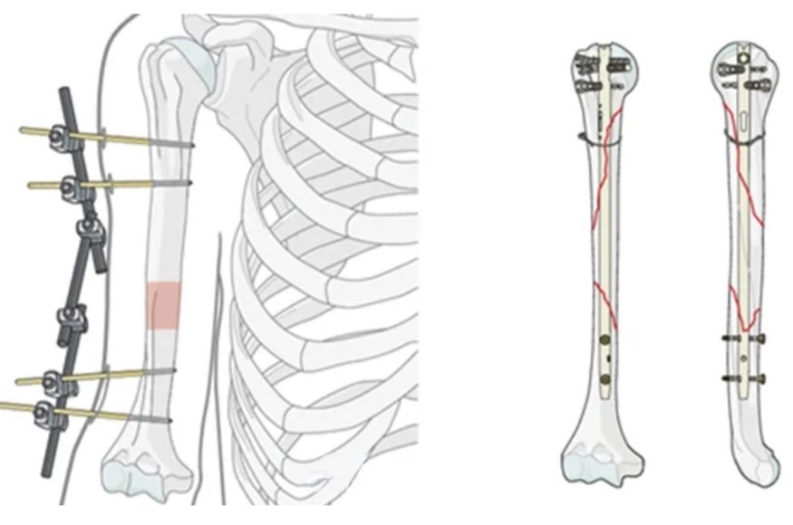 операция - остеосинтез при переломах конечностей